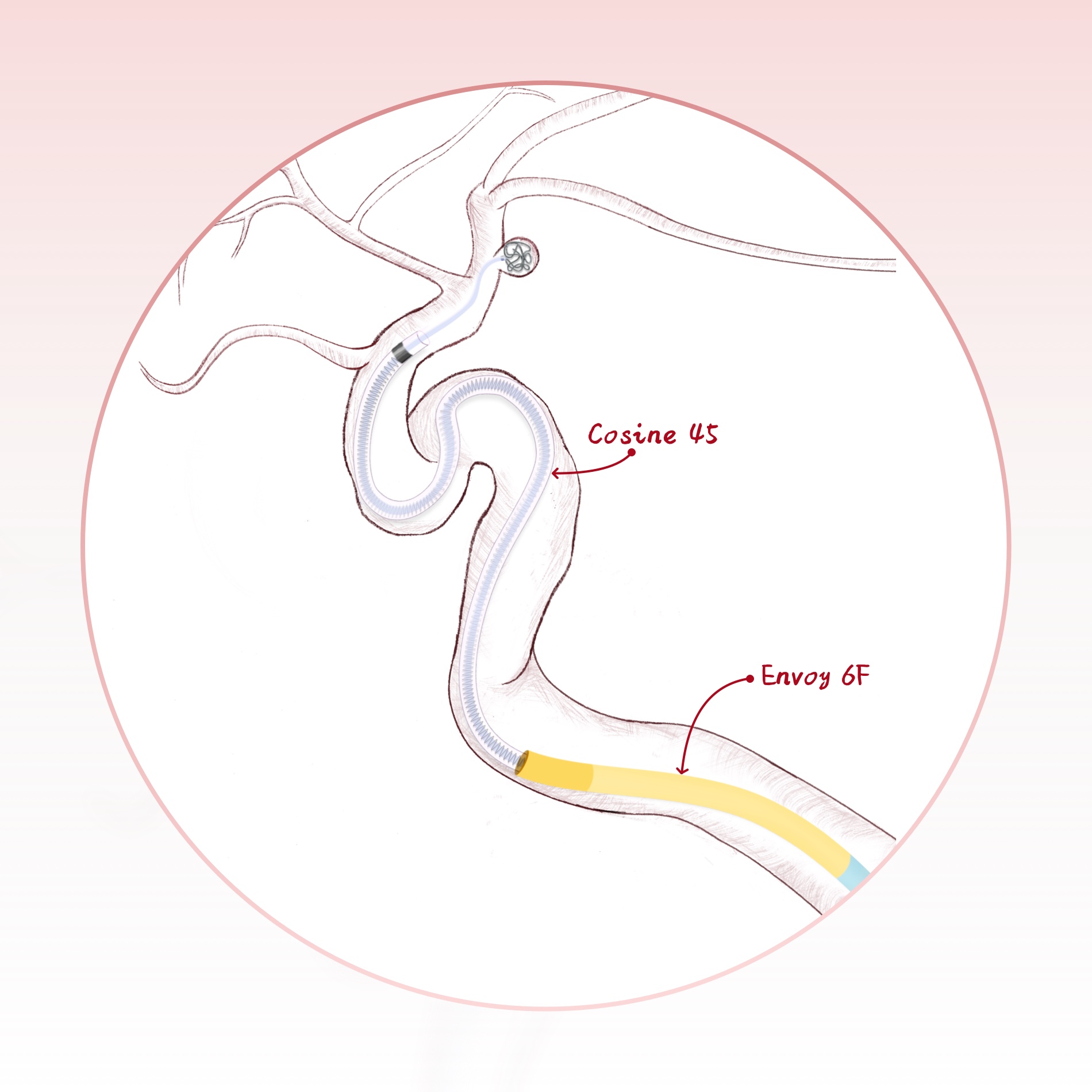 Coiling for Aneurysms in Distal or Tortuous Vessels - Transradial|Transfemoral